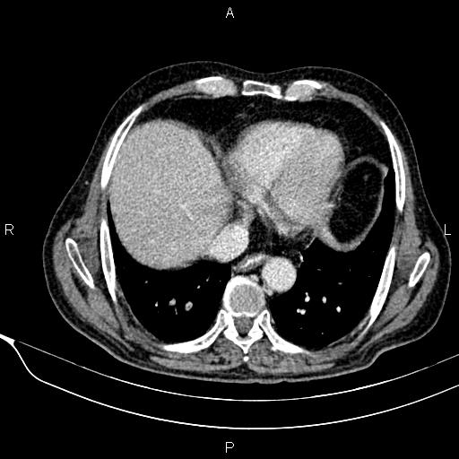 Acute pancreatitis (Radiopaedia 85146-100701 Axial C+ portal venous phase 11).jpg