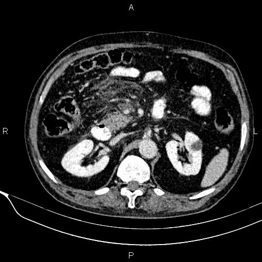 Acute pancreatitis (Radiopaedia 85146-100701 Axial C+ portal venous phase 27).jpg