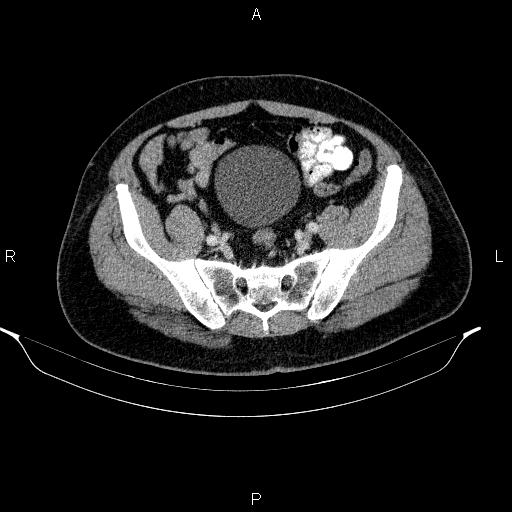 Acute pancreatitis (Radiopaedia 85390-101010 Axial C+ portal venous phase 85).jpg