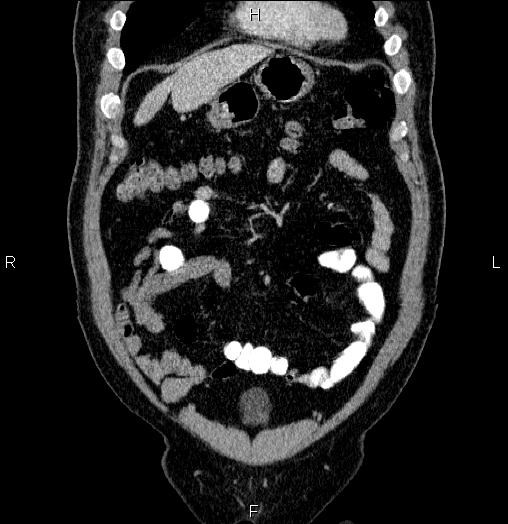 Acute pancreatitis (Radiopaedia 85390-101010 Coronal C+ portal venous phase 12).jpg