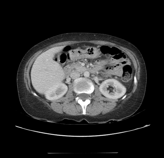 Acute pancreatitis - Balthazar E - post ERCP (Radiopaedia 27562-27772 Axial C+ portal venous phase 31).png