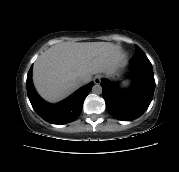 File:Acute pancreatitis - Balthazar E - post ERCP (Radiopaedia 27562-27772 Axial non-contrast 5).png