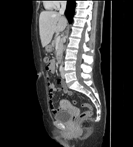 File:Acute pancreatitis - Balthazar E - post ERCP (Radiopaedia 27562-27772 Sagittal C+ portal venous phase 65).png