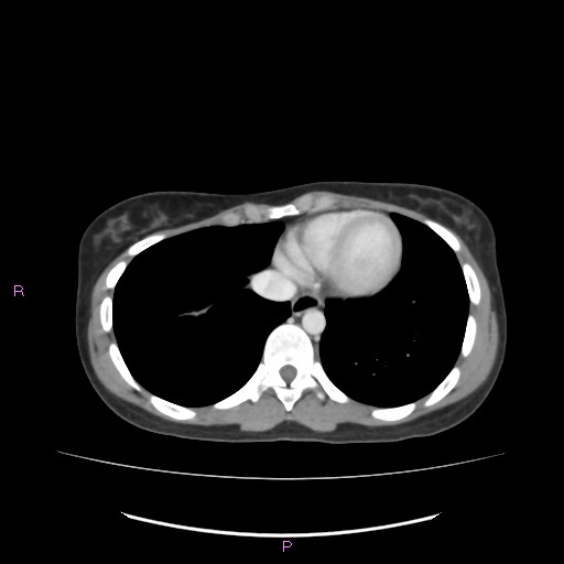 Acute pancreatitis secondary to stone at minor papilla and pancreatic divisum (Radiopaedia 76570-88333 Axial C+ portal venous phase 7).jpg
