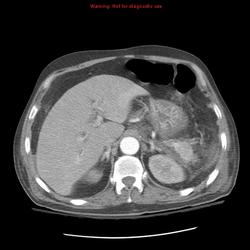 Acute pancreatitis with incidental pancreatic lipoma (Radiopaedia 10190-10730 Axial C+ arterial phase 28).jpg