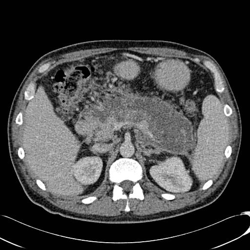 File:Acute pancreatitis with walled off pancreatic necrosis (Radiopaedia 6438-7797 Axial C+ portal venous phase 5).jpg