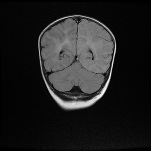 File:Acute phase of hemiconvulsion-hemiplegia epilepsy syndrome (Radiopaedia 29309-29745 Coronal FLAIR 17).jpg