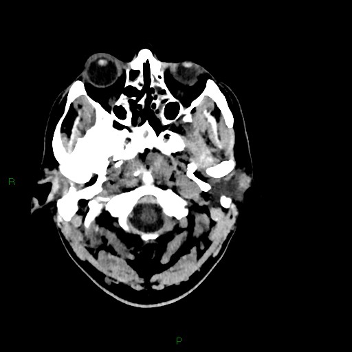 Acute posterior cerebral artery territory infarct (Radiopaedia 79329-92393 Axial non-contrast 10).jpg