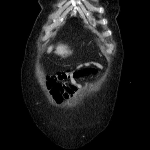 Acute pyelonephritis (Radiopaedia 26584-26729 C+ portal venous phase 12).jpg