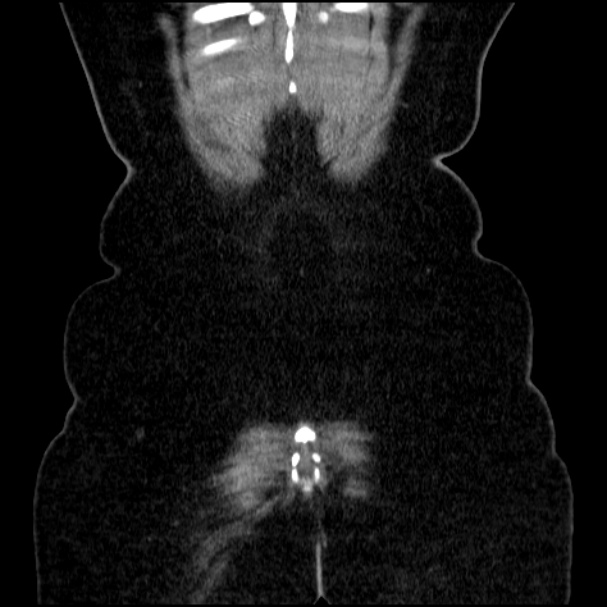 Acute pyelonephritis (Radiopaedia 33397-34434 Coronal renal parenchymal phase 70).jpg