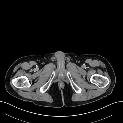 Acute renal infarction (Radiopaedia 59375-66736 Axial C+ portal venous phase 132).jpg