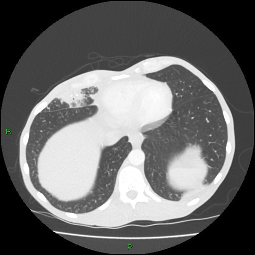 Acute right lung abscess (Radiopaedia 34806-36258 Axial lung window 152).jpg