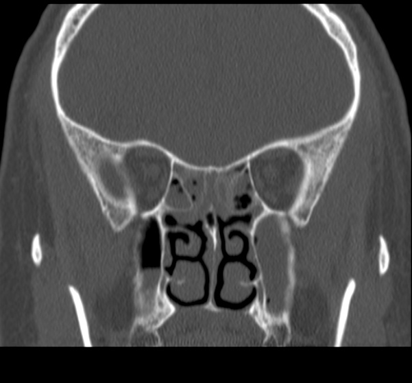 Acute sinusitis (Radiopaedia 23161-23215 Coronal bone window 41).jpg