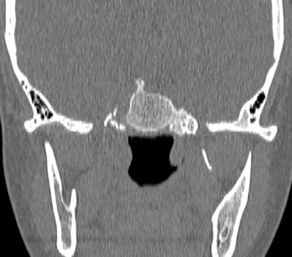 File:Acute sinusitis (Radiopaedia 40564-43158 Coronal bone window 44).jpg