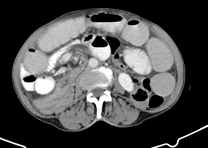 File:Acute small bowel (ileal) volvulus (Radiopaedia 71740-82139 Axial C+ portal venous phase 105).jpg