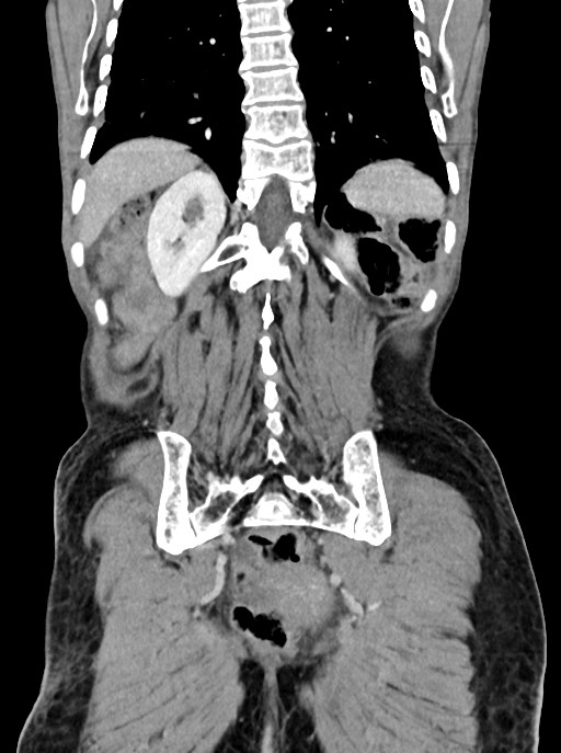 Acute small bowel (ileal) volvulus (Radiopaedia 71740-82139 Coronal C+ portal venous phase 90).jpg