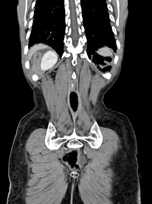Acute small bowel (ileal) volvulus (Radiopaedia 71740-82139 Coronal C+ portal venous phase 97).jpg