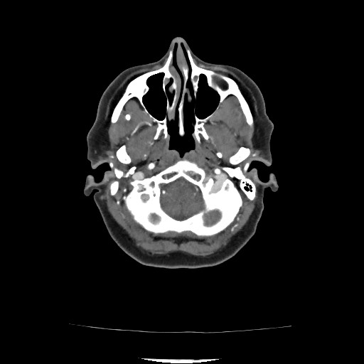 Acute subarachnoid hemorrhage and accessory anterior cerebral artery (Radiopaedia 69231-79009 Axial C+ arterial phase 77).jpg