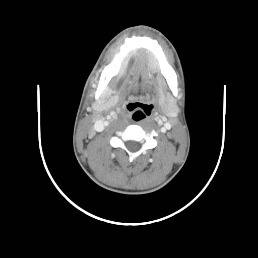 File:Acute submandibular sialadenitis secondary to ductal stone (Radiopaedia 27999-28267 Axial C+ delayed 23).jpg