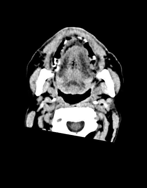 Acute superior cerebellar artery territory infarct (Radiopaedia 84104-99359 Axial non-contrast 76).jpg
