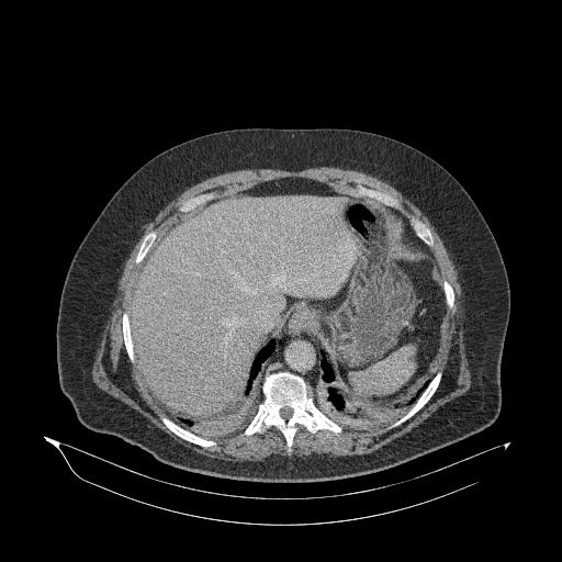 Acute superior mesenteric artery occlusion (Radiopaedia 51288-56960 Axial C+ portal venous phase 15).jpg