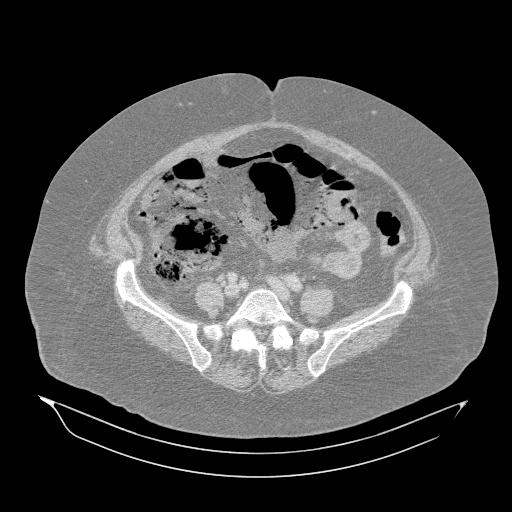 Acute superior mesenteric artery occlusion (Radiopaedia 51288-56960 Axial lung window 49).jpg