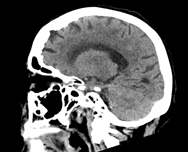 Acute traumatic subdural hematoma (Radiopaedia 82921-97257 Sagittal non-contrast 31).jpg