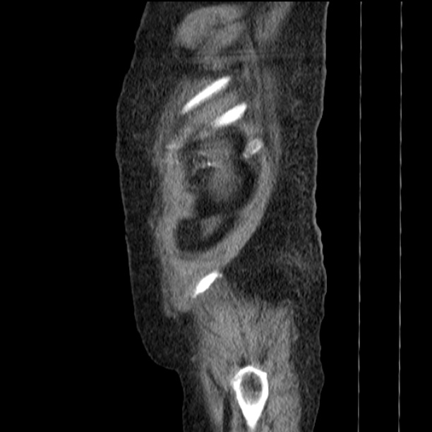 Acute tubular necrosis (Radiopaedia 28077-28334 H 79).jpg