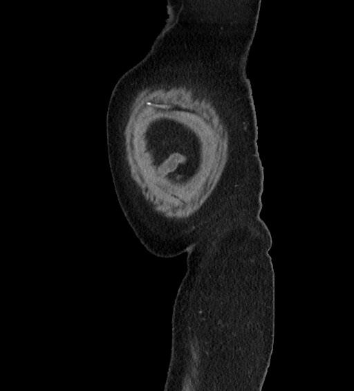 Acute uncomplicated sigmoid diverticulitis (Radiopaedia 82003-95987 Sagittal C+ portal venous phase 3).jpg
