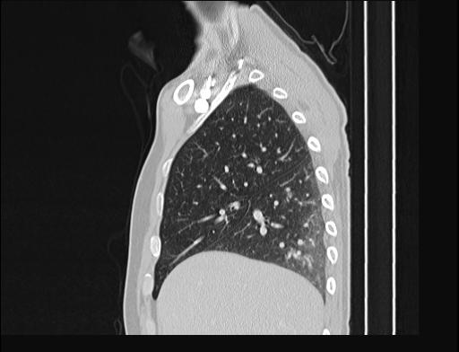 Addison disease (Radiopaedia 49318-54412 Sagittal lung window 47).jpg