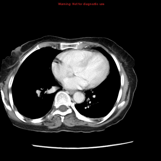 File:Adenocarcinoma of the colon (Radiopaedia 8191-9039 Axial liver window 1).jpg
