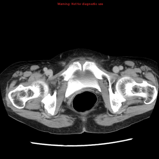 Adenocarcinoma of the colon (Radiopaedia 8191-9039 Axial renal excretory phase 60).jpg