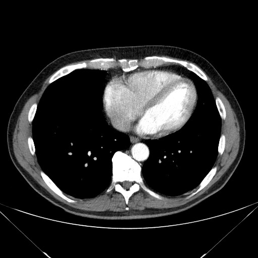File:Adenocarcinoma of the lung (Radiopaedia 59871-67325 Axial C+ arterial phase 66).jpg
