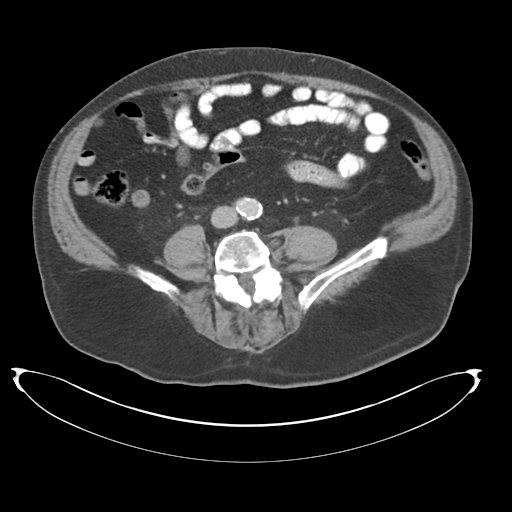 Adenocarcioma of rectum- T1 lesion (Radiopaedia 36921-38547 Axial C+ portal venous phase 56).png