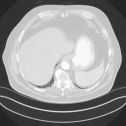 Adenocarcioma of rectum- T1 lesion (Radiopaedia 36921-38547 Axial lung window 47).png