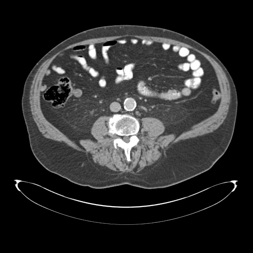 Adenocarcioma of rectum- T1 lesion (Radiopaedia 36921-38547 Coronal C+ portal venous phase 1).png