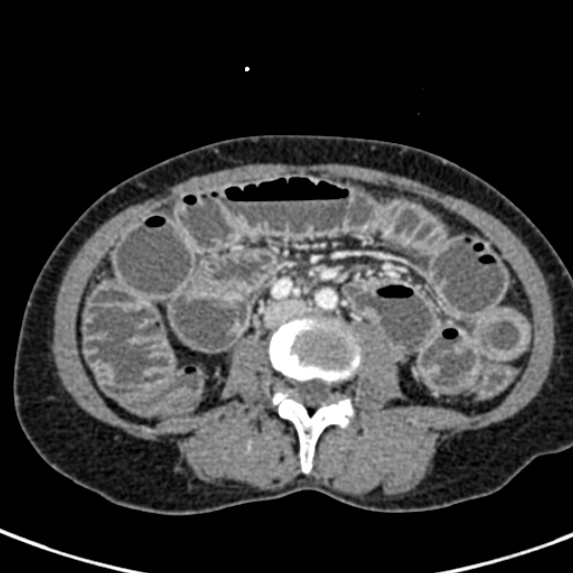 Adhesional small bowel obstruction (Radiopaedia 48397-53305 Axial C+ portal venous phase 45).jpg