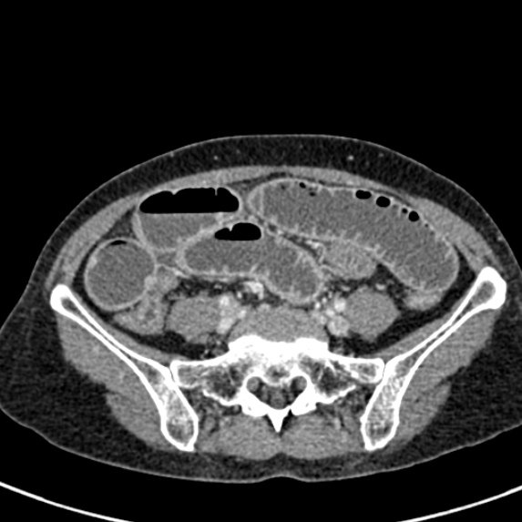 Adhesional small bowel obstruction (Radiopaedia 48397-53305 Axial C+ portal venous phase 63).jpg