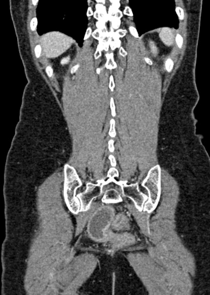 Adhesional small bowel obstruction (Radiopaedia 48397-53305 Coronal C+ portal venous phase 295).jpg