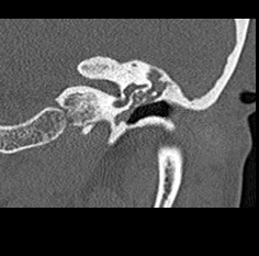 File:Adhesive chronic otitis media (Radiopaedia 14270-14148 Coronal bone window - left 13).jpg