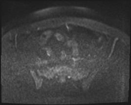 Adnexal multilocular cyst (O-RADS US 3- O-RADS MRI 3) (Radiopaedia 87426-103754 Axial DWI 64).jpg