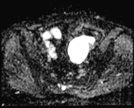 File:Adnexal multilocular cyst (O-RADS US 3. O-RADS MRI 3) (Radiopaedia 87426-103754 Axial 163).jpeg