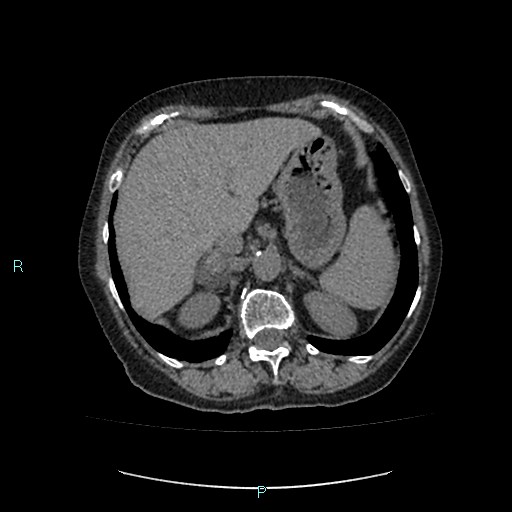 File:Adrenal collision tumor (ACT) (Radiopaedia 48462-53379 Axial non-contrast 12).jpg