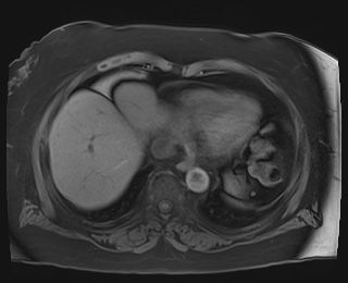 Adrenal cortical carcinoma (Radiopaedia 64017-72770 Axial T1 fat sat 1).jpg