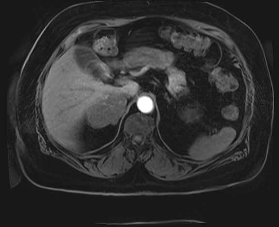Adrenal cortical carcinoma (Radiopaedia 64017-72770 H 6).jpg