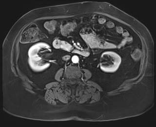 Adrenal cortical carcinoma (Radiopaedia 64017-72770 I 52).jpg