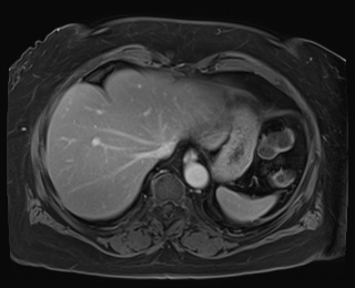 Adrenal cortical carcinoma (Radiopaedia 64017-72770 K 7).jpg