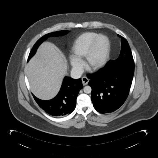 File:Adrenal cyst (Radiopaedia 45625-49776 Axial C+ portal venous phase 10).png