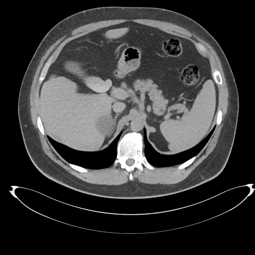 Adrenal cyst (Radiopaedia 45625-49778 AXIAL THICK 15 min 16).png
