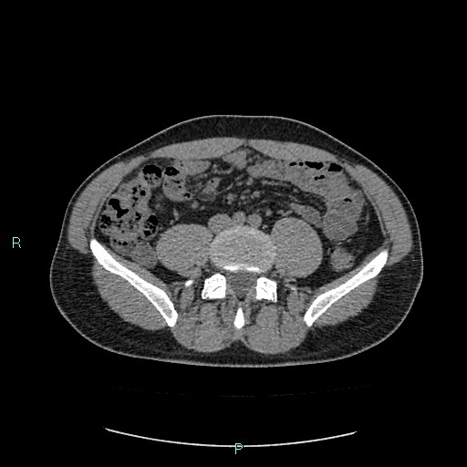 Adrenal cystic lymphangioma (Radiopaedia 83161-97534 Axial non-contrast 61).jpg